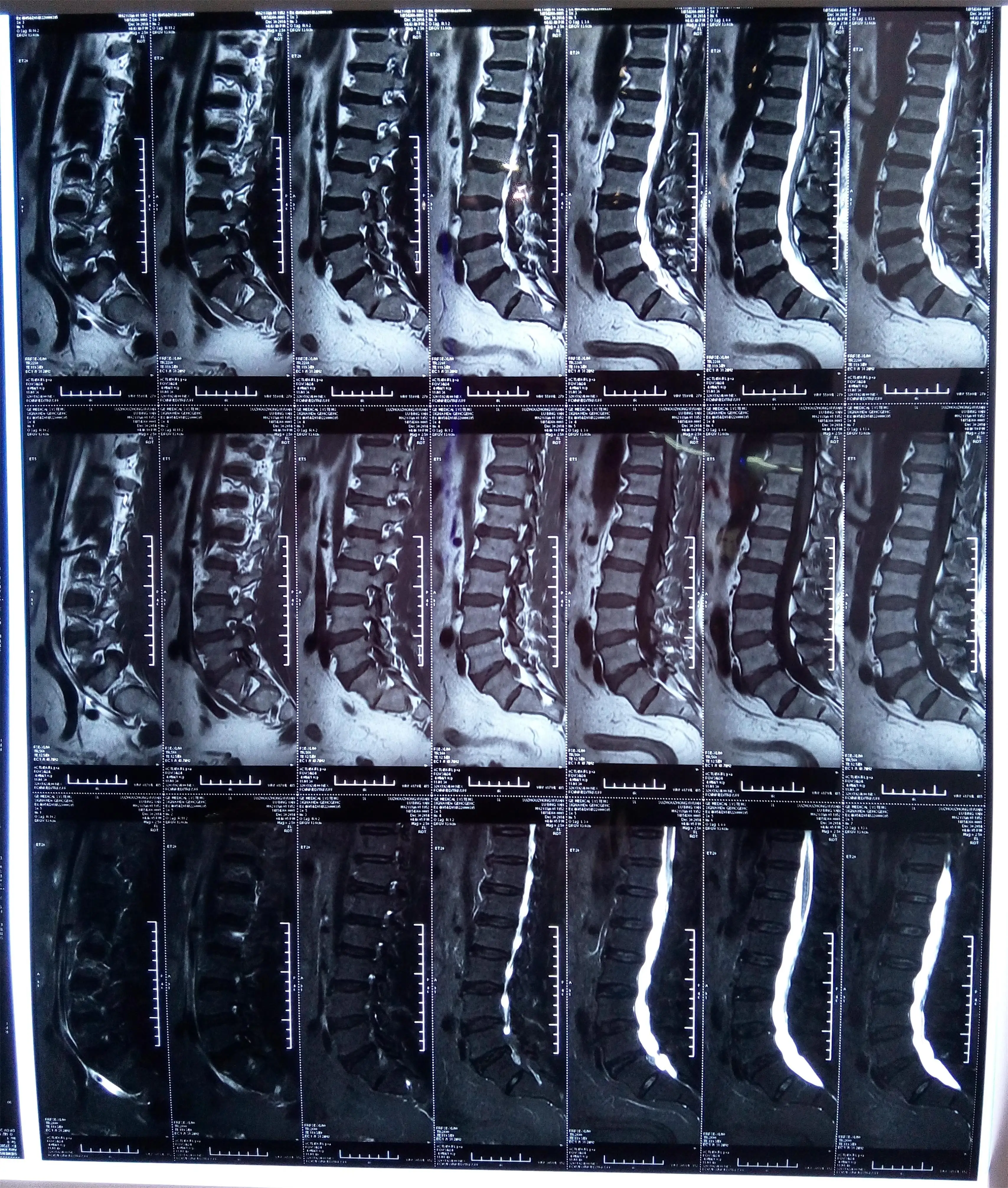 
high resolution medical dry imaging film x-ray digital blue film for ct cr mri diagnosis from China 