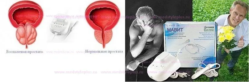 
MAVIT - The device for erectile dysfunction and chronic prostatitis treatment. 