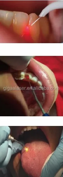 dental laser for Exposure of implants/ 980nm diode dental laser