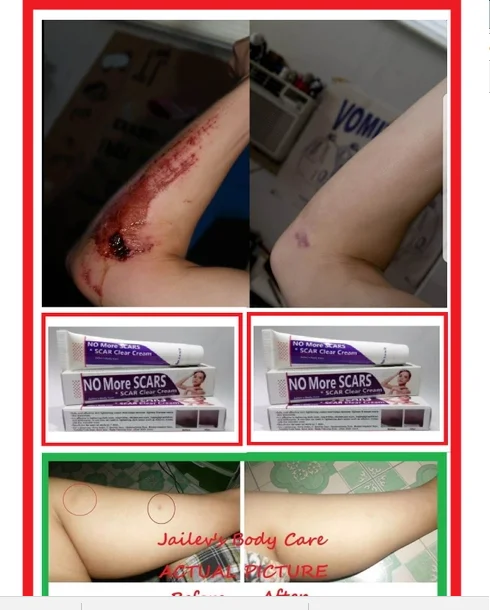 
No More Scars Scar Removal Cream for Dark Scars 