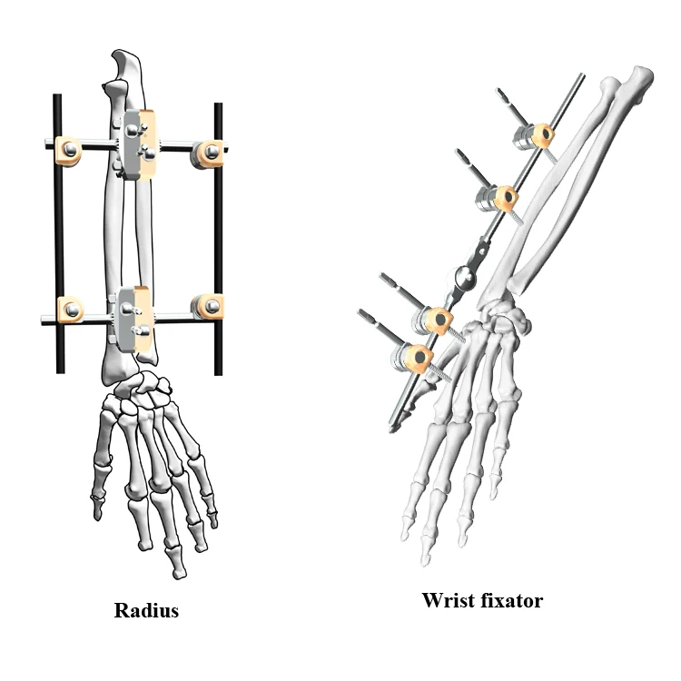 Ортопедический комбинированный 5 мм внешняя фиксация маленький костный фрагмент фиксатор верхней конечности ульна радиус коленчатый инструмент hoffman Stryker