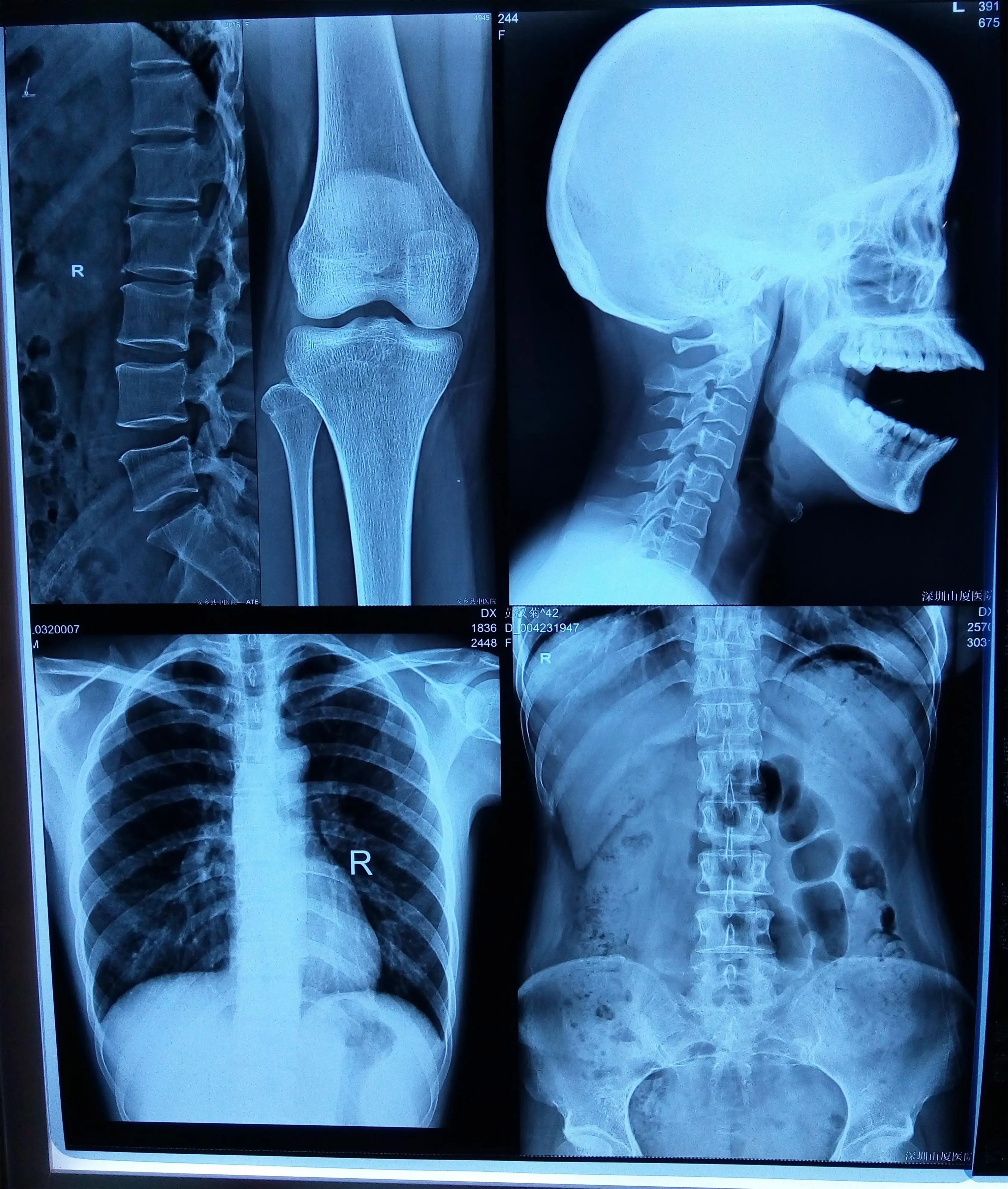 8*10 china made pet base double blue sensitive film medical x ray imaging film for printing on radiology machine