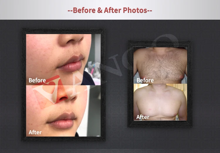 Permanent hair removal beauty machine about 1200w 808 laser