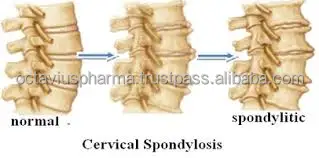 
Boswellia Serrata Capsules for Arthritis 