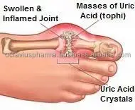 
Boswellia Serrata Capsules for Arthritis 