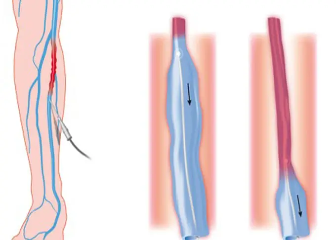 Varicose Veins - 1470nm laser Endovenous  medical laser surgical equipment