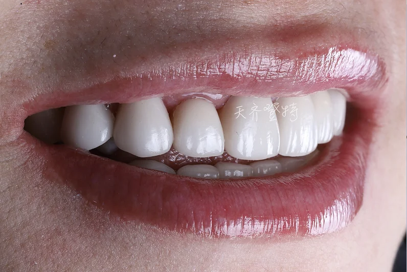 Виниры с идеальной улыбкой для отбеливания зубов