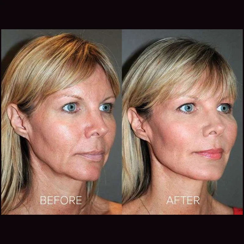 Beauty skin care absorbable sutures 25mm mono lift vline face nose blunt cannula pdo thread