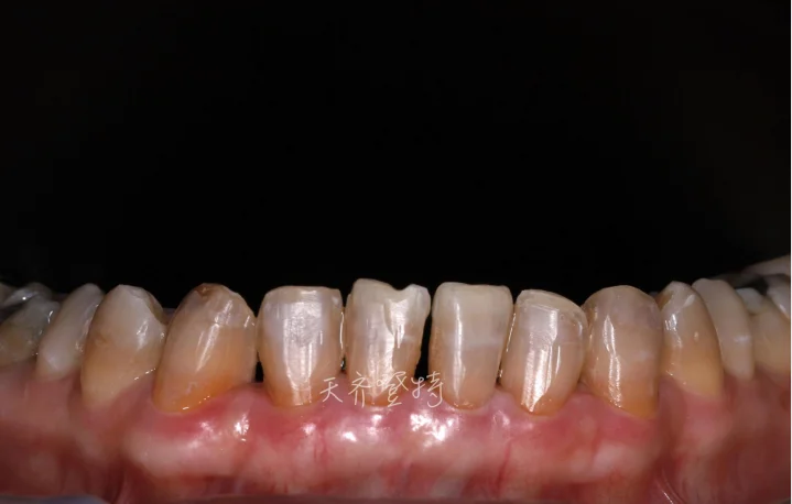 Виниры с идеальной улыбкой для отбеливания зубов