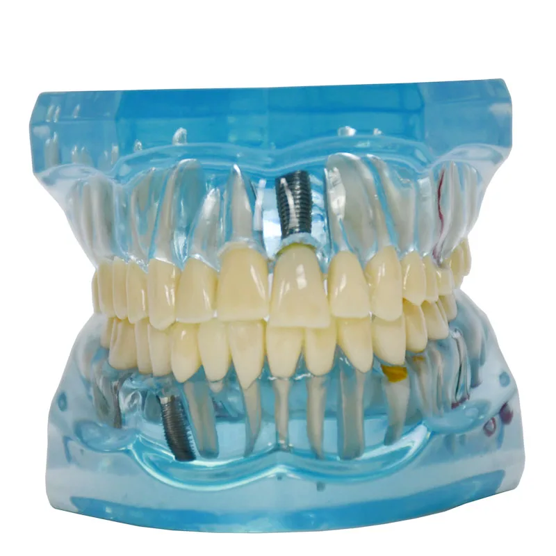 Производство, изготовление на заказ, прозрачная, для взрослых, патологическая, Стоматологическая модель для обучения зубам, демонстрация зубных имплантов