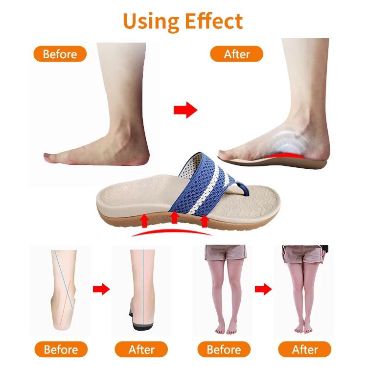 Фабрика унисекс высокого качества для большого пальца стопы можно-помощник с открытым носком обувь коррекции осанки ортопедические сандалии