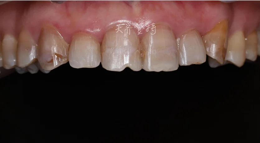 Виниры с идеальной улыбкой для отбеливания зубов
