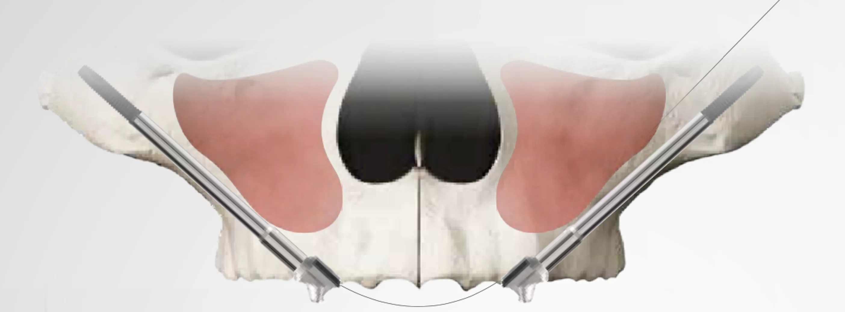 
High quality diameters of 3,75 mm 11 different lenghts zygomatic Dental Implant 