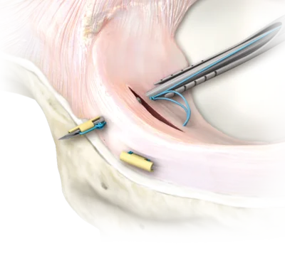 MENISCAL REPAIR  DEVICE MENISCUS SUTURE