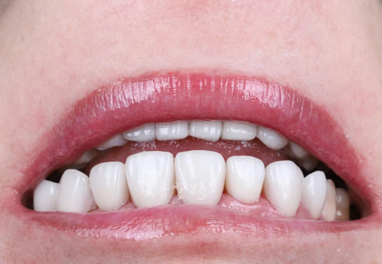 Виниры с идеальной улыбкой для отбеливания зубов