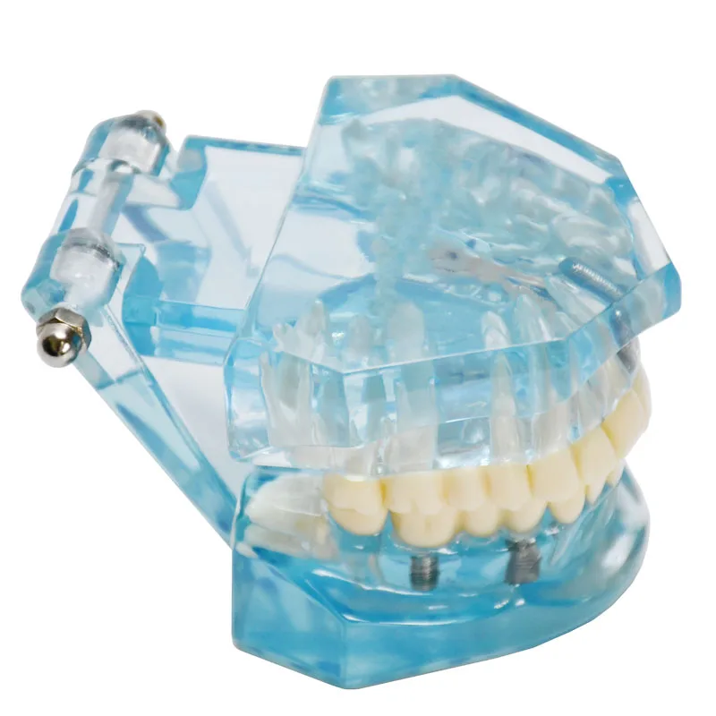 Производство изготовление на заказ прозрачная для взрослых патологическая Стоматологическая модель обучения зубам демонстрация зубных имплантов