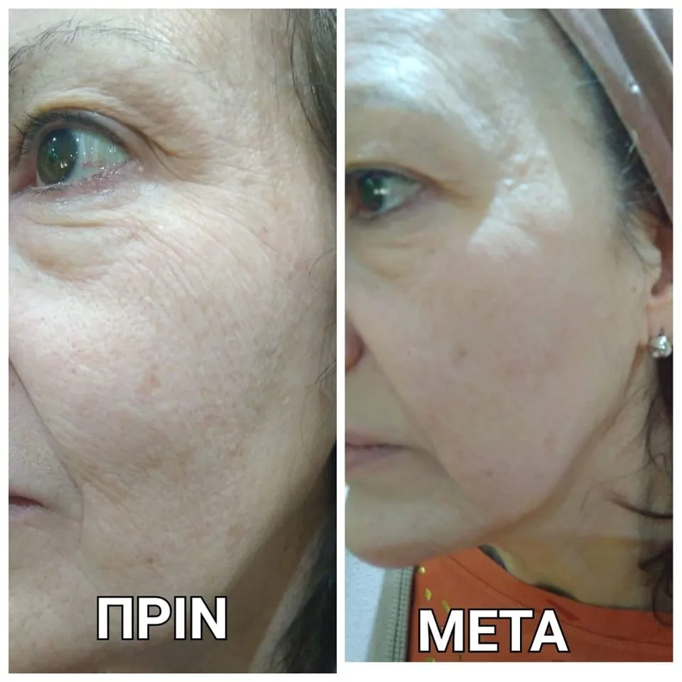 Multifunction IPL+Elight+ OPT   hair removal machine Hair Removal Laser Beauty Equipment For Blood Vessels Removal