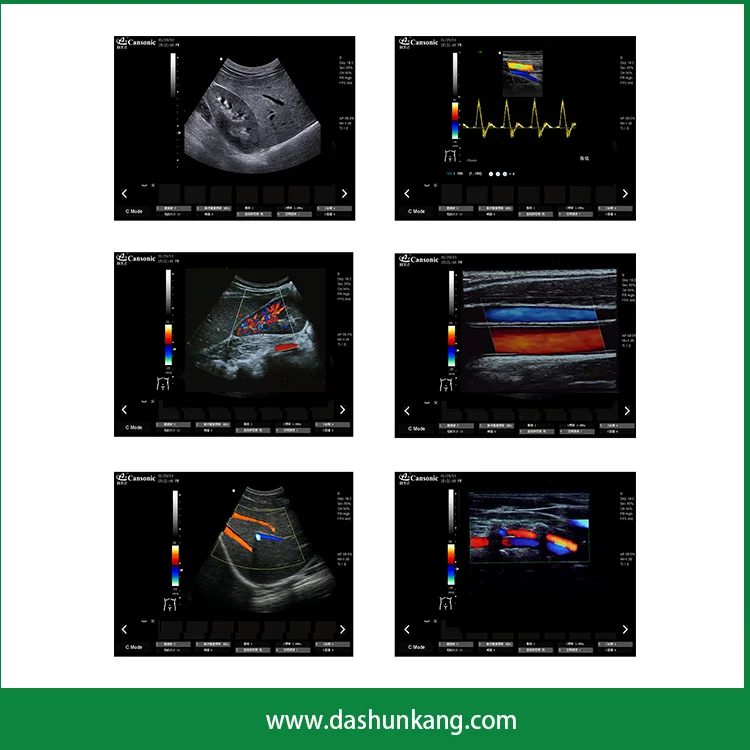 DSC Color Doppler 1700A Color Doppler System Sonoscape E1Exp Ultrasonido Doppler A Color Cansonic Medical Ultrasound Instruments