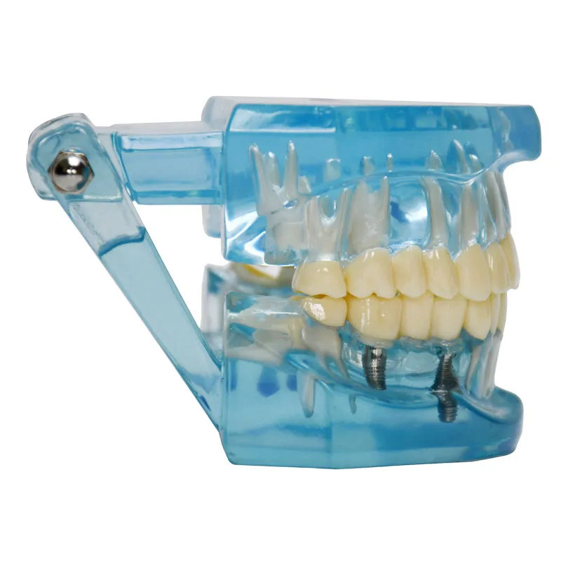 Производство изготовление на заказ прозрачная для взрослых патологическая Стоматологическая модель обучения зубам демонстрация зубных имплантов