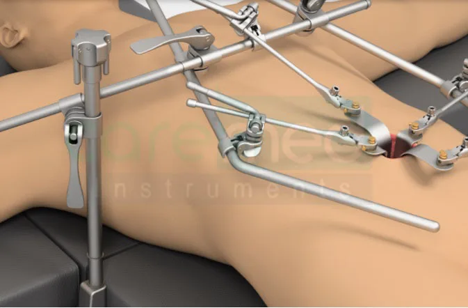 Professional Surgical Thompson Retractor System For Liver Transplant By Pakistani Manufacturer | Caremed Instruments