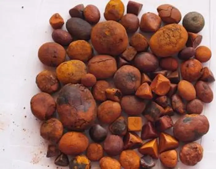 Gallstones .jpeg