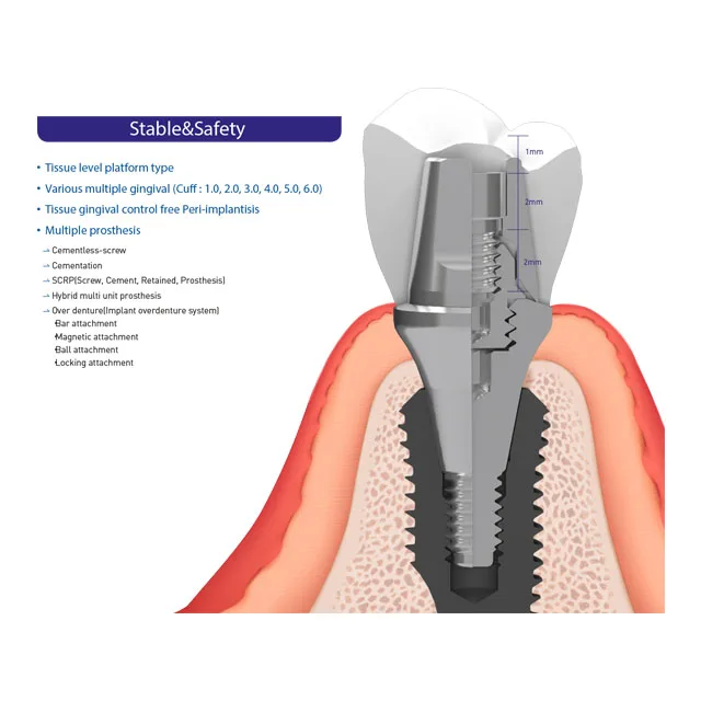  Гибридный многоблочный протез стабильный абатмент шестигранного типа для стоматологической хирургии Сделано в Корее