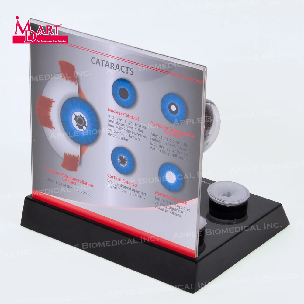 
Human eye model with replaceable disease cataract lens in medical science 