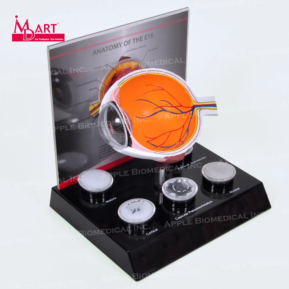
Human eye model with replaceable disease cataract lens in medical science 