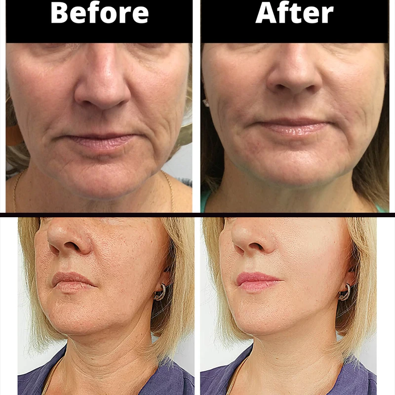 Beauty skin care absorbable sutures 25mm mono lift vline face nose blunt cannula pdo thread