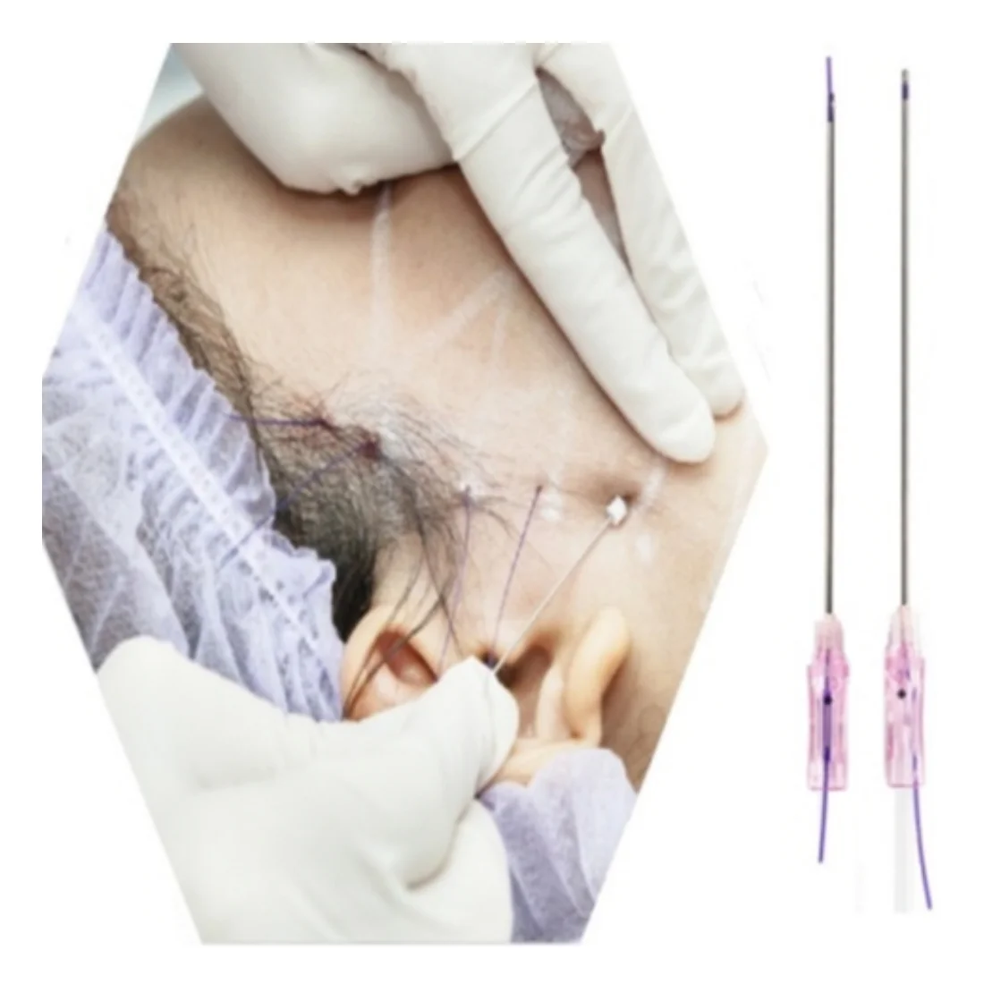 
Обычно используется для регулировки громкости [LUXX], резьба для лифтинга лица в Корее, LUXX CANNULA W, PLLA, PDO,PCL 