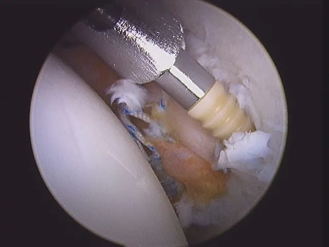 Anchor Orthopedic Surgery Implant Materials & Artificial Organs Knotless Anchor - Crossft Class II Lifetime Accepted Orthosyn