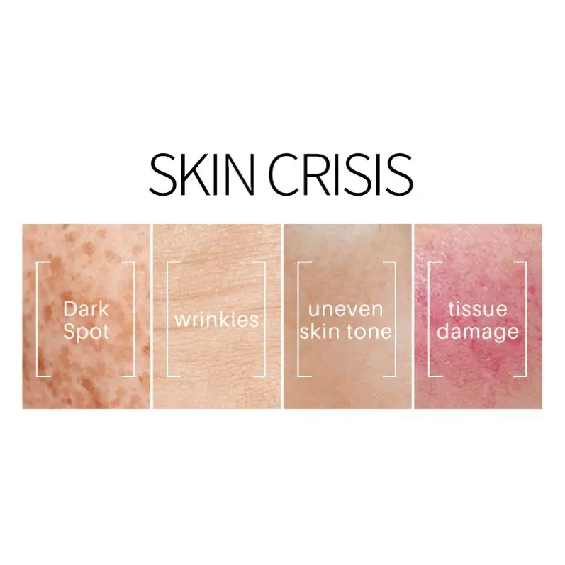 XBY Hot Selling Private Label Herbal GMP Acne Scar Skin Renew Dark Spot Corrector Remover Cream For Face Body Black Skin